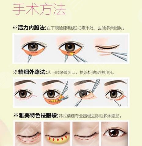 手術(shù)去眼袋