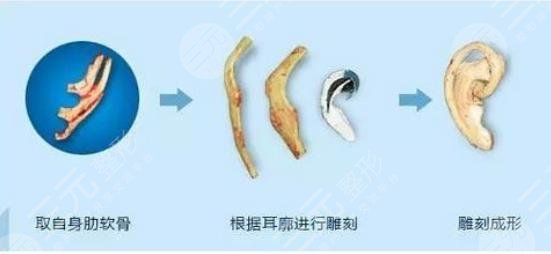 外耳再造手術(shù)需要多少費用？價格表大全，匯總分享！