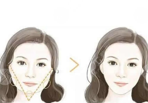 面部輪廓固定需要多少錢？