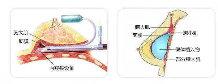 內(nèi)窺鏡隆胸的技術(shù)優(yōu)勢(shì)