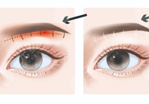 提眉術(shù)多久可以恢復(fù)自然？