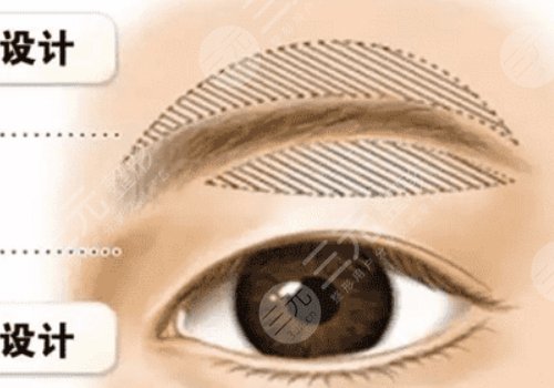 提眉術(shù)多久可以恢復(fù)自然？