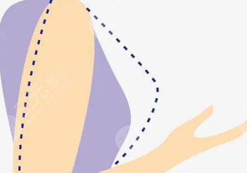 林沸騰醫(yī)生內(nèi)窺鏡隆胸怎么樣？