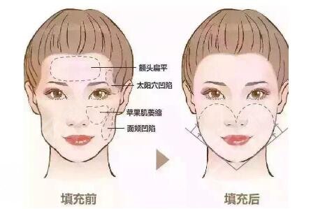 自體脂肪二次填充時(shí)間是什么時(shí)候?