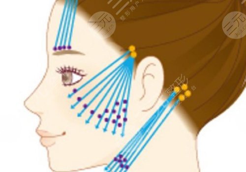 做完線雕多久可以恢復？