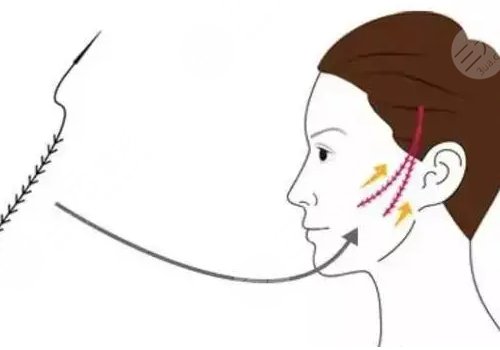 做完線雕多久可以恢復？