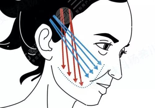 做完線雕多久可以恢復？