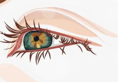 開眼角割雙眼皮恢復(fù)期要多久？