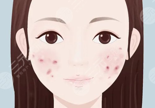 痘印怎么消除？