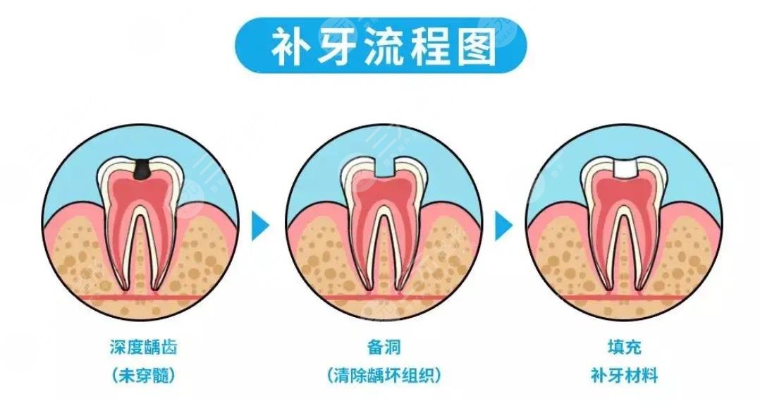 補(bǔ)牙封藥后疼正?常嗎?