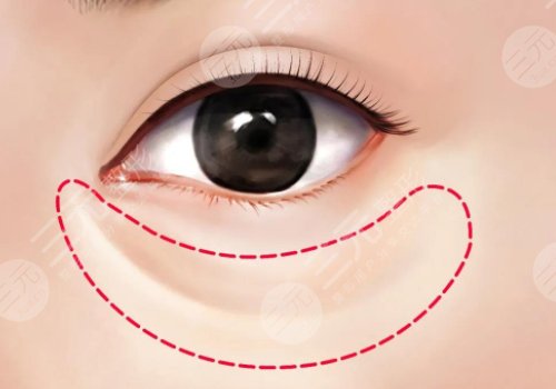 淚溝是怎么形成的？