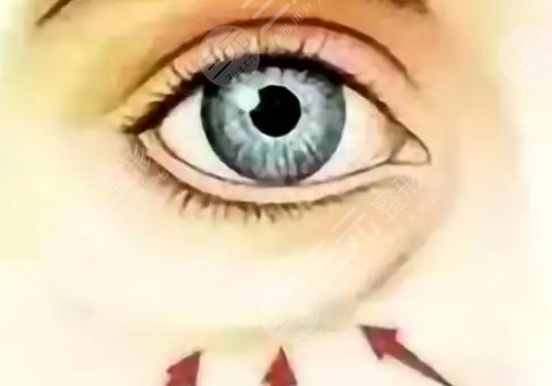 淚溝是怎么形成的？