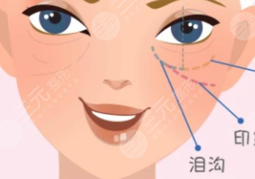 淚溝是怎么形成的？