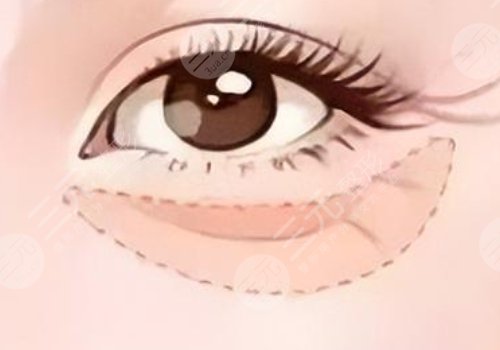 淚溝是怎么形成的？