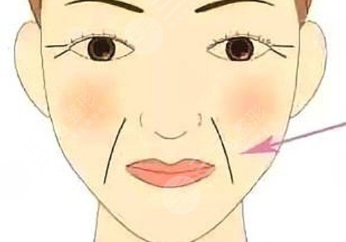 法令紋太深了有什么解決辦法？