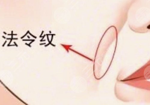 法令紋太深了有什么解決辦法？