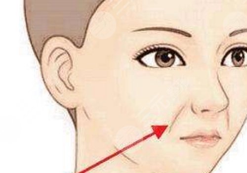 法令紋太深了有什么解決辦法？