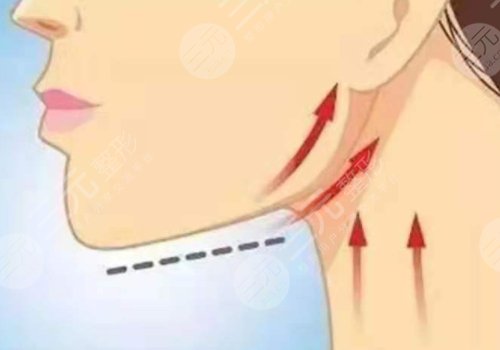 下頜緣提升怎么打？