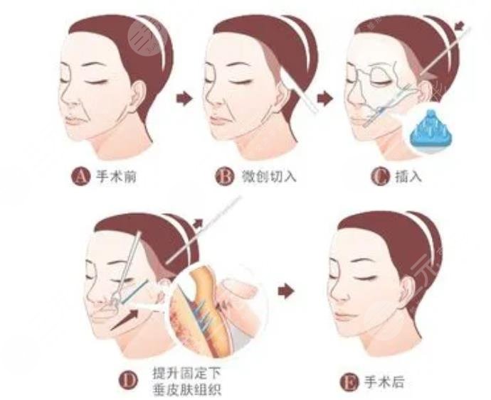雙矢量提升術(shù)多大歲數(shù)能做