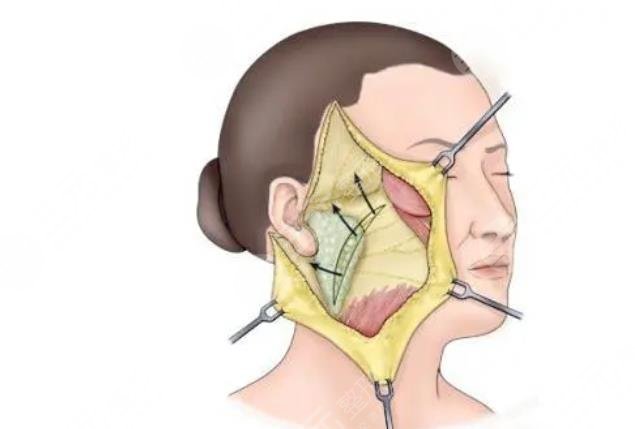 臉部雙矢量組織復位術