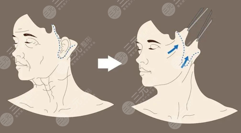 臉部雙矢量組織復位術