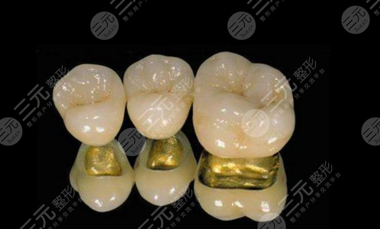 金鈀烤瓷牙價(jià)格一般是多少?