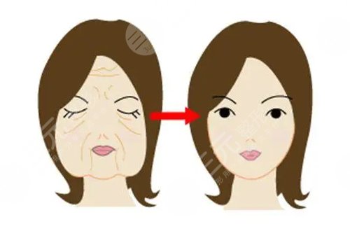 韌帶提升和拉皮的區(qū)別是什么？