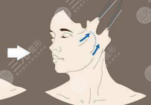 韌帶提升和拉皮的區(qū)別是什么？