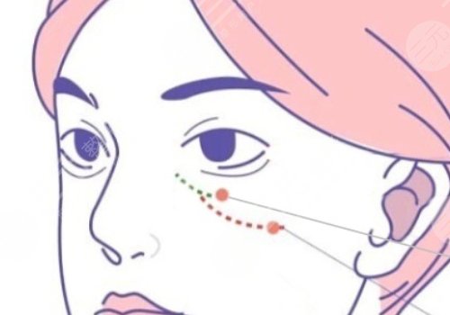 雙美膠原蛋白填充淚溝能維持多久？