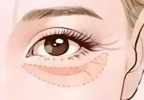 雙美膠原蛋白填充淚溝能維持多久？