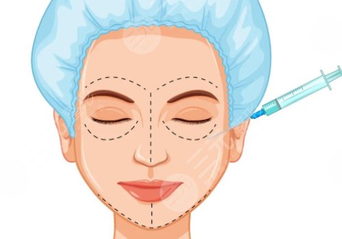 雙美膠原蛋白填充淚溝能維持多久？