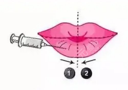 玻尿酸豐唇多久消腫？能維持多久？