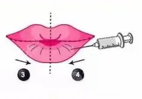 玻尿酸豐唇多久消腫？能維持多久？