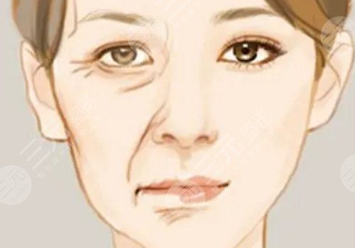 括號紋怎么去掉？怎么形成的？改良方式解讀！