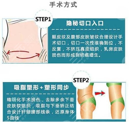 腰腹抽脂腹壁整形恢復期要多久？重塑小蠻腰，這些事你要知道！