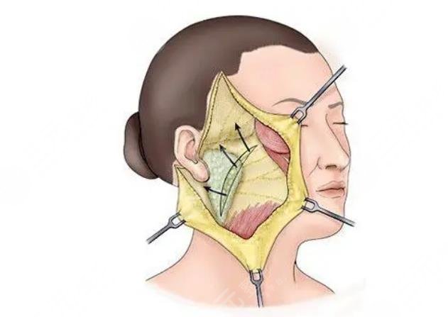 上海吳佳君醫(yī)生拉皮案例