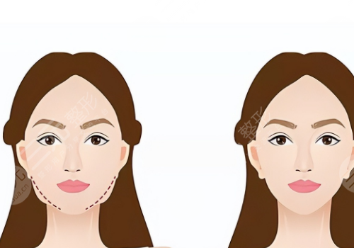 輪廓針一般打幾針