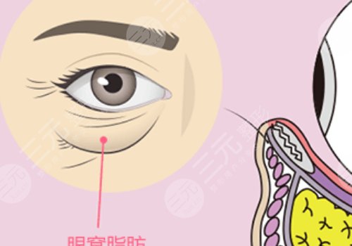 眼窩凹陷用什么填充好？