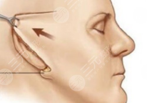 筋膜懸吊術(shù)適合多大年齡的？