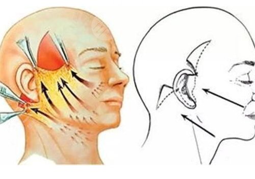 筋膜懸吊術(shù)適合多大年齡的？