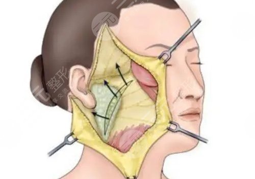 筋膜懸吊術(shù)適合多大年齡的？