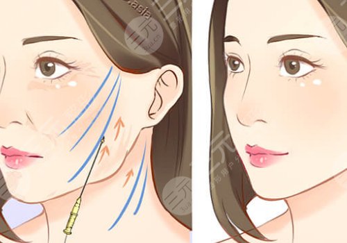 筋膜懸吊術(shù)適合多大年齡的？