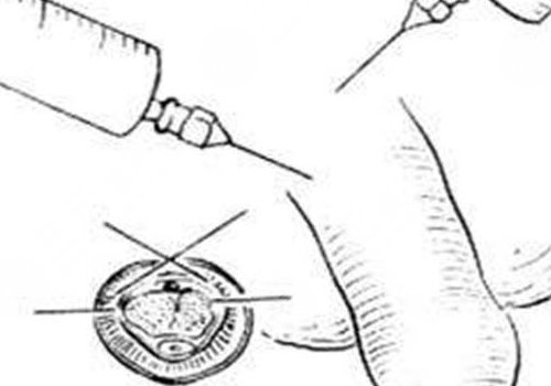 玻尿酸男性增大注射要多少錢？