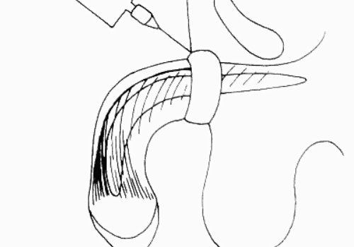 玻尿酸男性增大注射要多少錢？