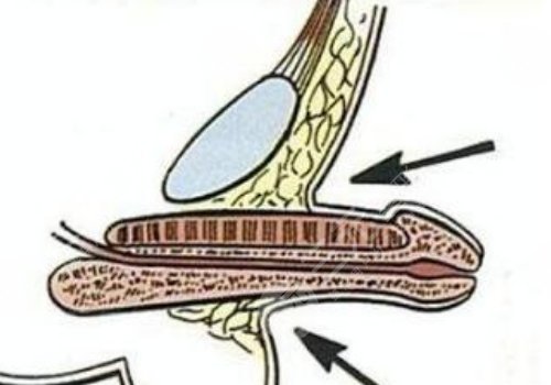 玻尿酸男性增大注射要多少錢？