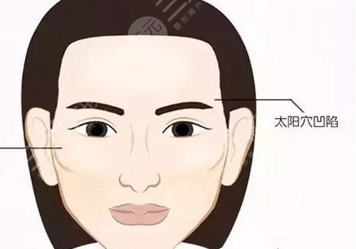 玻尿酸填充太陽凹大概多少錢？