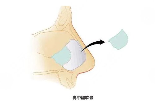 靳玉彪做的鼻子怎么樣？
