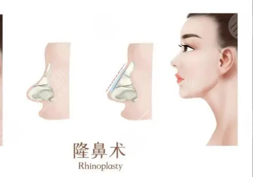 靳玉彪做的鼻子怎么樣