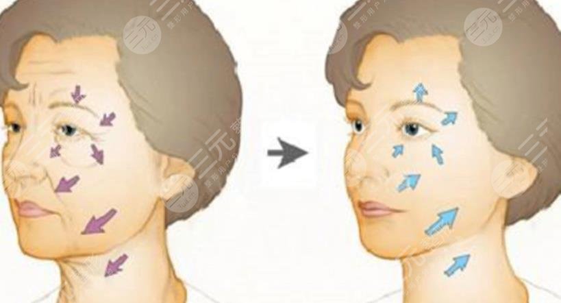 小切口面部提升