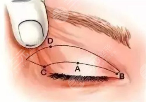 做眼部提拉手術能維持多久？